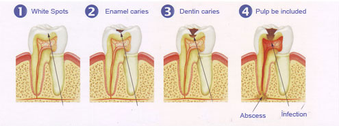The stages of dental decay