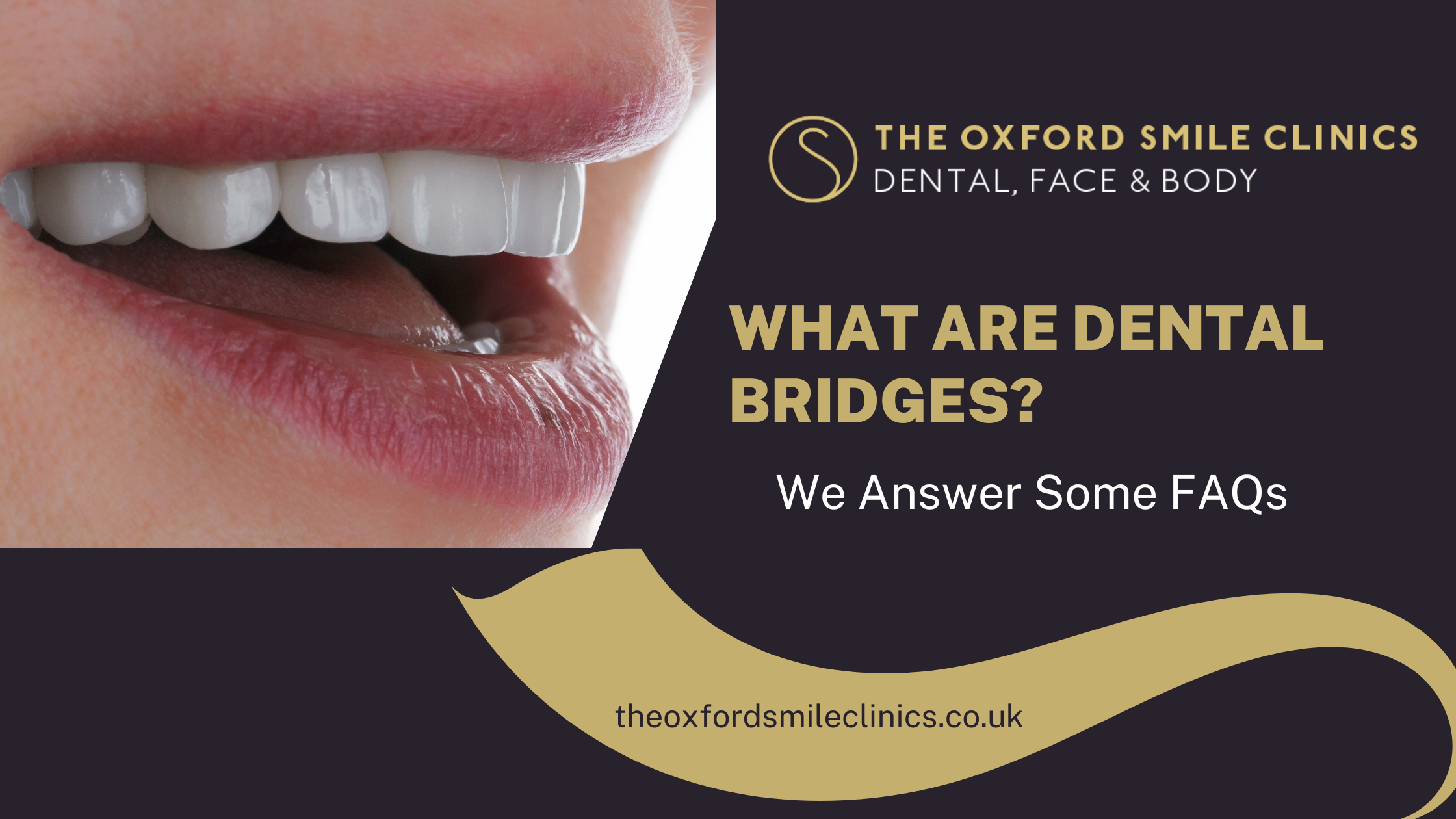 When we talk about missing teeth, the first thing that comes to mind is removable dentures. But have you ever wondered if there are any tooth replacement options available other than dentures? Of course, there is! Have you heard of dental bridges? If not, don’t worry; this blog contains all the information you need to decide whether a dental bridge is the right option to replace missing teeth. So, read through the entire blog to get all your questions about dental bridges answered. What Are Dental Bridges? According to the American College of Prosthodontists, a bridge is a fixed prosthesis used for replacing one or more missing adjacent natural teeth. Unlike a removable denture that can be removed and inserted at the patient’s will, a bridge takes support from the healthy natural teeth on either side and remains fixed to them. Therefore, a bridge can only be used for tooth replacement in patients who still have a few natural teeth left in their mouth to support the prosthesis. What Are The Different Types of Dental Bridges? According to the Cleveland Clinic, there are four different types of dental bridges based on their design: Traditional Bridges - These bridges take support from healthy teeth on both sides. Crowns are attached to both sides of the bridge that sit on the prepared natural teeth and prevent the prosthesis from moving unnecessarily. The artificial teeth used for replacing the missing teeth in a bridge are called pontics. These bridges are used when healthy natural teeth are available on both sides of the missing teeth gap. Cantilever Bridges - As the name suggests, these bridges take support from the natural teeth only on one side. These bridges are used when natural supporting teeth are only available on one side of the missing teeth gap. Maryland Bridge - This bridge has a different design than the traditional and cantilever bridge. Instead of taking support from the natural teeth through crowns (abutments), these bridges are attached to the supporting teeth using a metal mesh. This mesh is bonded to the lingual (tongue-facing) surface of the teeth. These bridges are typically used for replacing the front missing teeth where heavy biting forces are not expected. Implant-supported Bridge - This bridge has a similar design to the conventional tooth-supported bridges. However, instead of natural teeth, they use dental implants for their support. What Are The Benefits of Dental Bridges? Dental implants offer several advantages over conventional removable dentures: Support - dental bridges remain fixed to the natural teeth. As a result, they provide superior support and chewing efficiency than removable dentures. Aesthetics - Dental bridges use aesthetically pleasing tooth-coloured ceramic pontics and abutments that help restore one’s smile and facial aesthetics. Durability - dental bridges tend to last considerably longer than removable dentures, which require frequent repair or replacement. How Do Dental Bridges Work? Dental bridges have the same design as architectural bridges. Like a road bridge is used for “bridging” a gap between two places, a dental bridge is used for bridging a gap created by one or more missing teeth. A bridge consists of abutments at both ends, which are crowns bonded to the supporting natural teeth. In between the abutments are pontics, the artificial teeth which will fill the gap. So, the abutments rest on natural teeth or implants and provide support for the pontics used for tooth replacement. What Is The Difference Between a Dental Crown And a Bridge? The primary difference between a crown and a bridge is that a crown is used for “restoring” a damaged tooth, while a bridge is used for replacing one or more missing teeth. You can consider a tooth bride as a prosthesis consisting of multiple crowns joined together, two abutments on both sides for support and the pontics in between them for tooth replacement. The number of pontics or crowns needed for a bridge depends on the number of missing teeth. What Is a Temporary Dental Bridge? The fabrication process of a dental bridge is typically completed between 2-3 sittings. During this time, patients prefer to have a temporary solution for their missing teeth. A temporary bridge is an appliance that is used for transiently replacing the missing teeth, while a permanent dental bridge is being fabricated in the dental laboratory. However, temporary bridges are not as strong and durable as the permanent ones. Therefore, they should not be used for eating and are only for aesthetic purposes. Once a patient’s bridges are received from the lab, their dentist will remove the temporary ones and bond the permanent ones in their place. How Long Does a Dental Bridge Typically Last? A bridge’s service life depends on various factors, such as the type of bridge, the quality of the material used for its fabrication, how well they are looked after by the patient, and the dentist’s skill. So, naturally, a traditional bridge will be considerably longer-lasting than a cantilever or Maryland bridge. Similarly, a bridge would last longer if its looked after carefully through optimal oral hygiene maintenance and by preventing its overloading. Typically, a tooth bridge can last up to ten years provided it is looked after well. If you live in Didcot and are considering a dental bridge for your missing teeth, you should consider Oxford Smile Clinics. Why? Because this practice has the best dental team in town and offers the highest-quality general and specialist dental services to its patients. So, request an initial consulation today and let us take care of your entire family’s dental health.