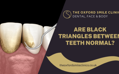 Are Black Triangles Between Teeth Normal?