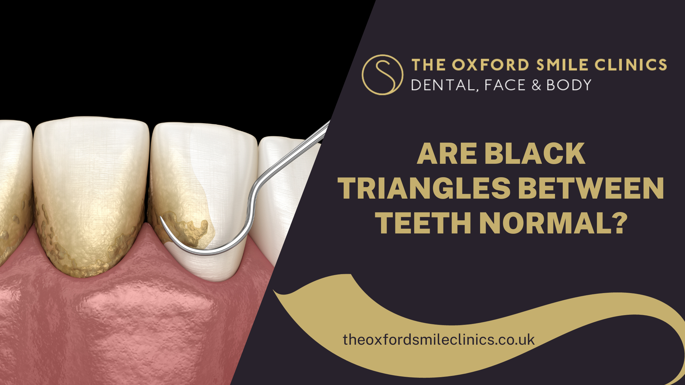 Are Black Triangles Between Teeth Normal?